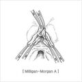excision_and_ligation01.jpg