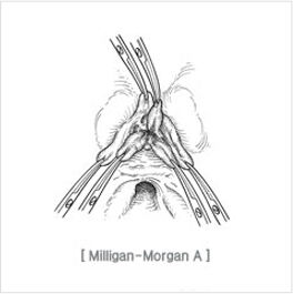 excision_and_ligation01.jpg