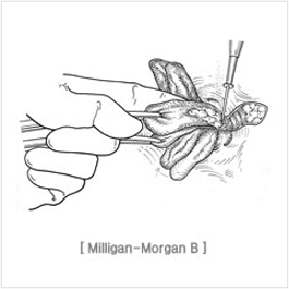 excision_and_ligation02.jpg