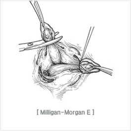 excision_and_ligation04.jpg