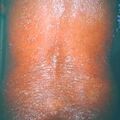 exfoliative1.jpg