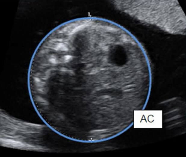 fetal_biometry-231807.png