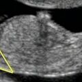 fetal_gender_11w_m.jpg