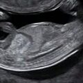 fetal_gender_12w_f.jpg