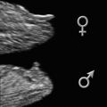 fetal_gender_angle.jpg