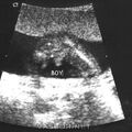 fetal_genitalia_boy_15-16_01.jpg