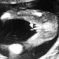 fetal_genitalia_boy_15-16_02.jpg