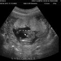 fetal_genitalia_boy_15-16_03.jpg