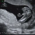 fetal_genitalia_boy_15-16_04.jpg