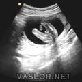 fetal_genitalia_boy_15-16_05.jpg