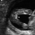 fetal_genitalia_girl_15-16_01.jpg