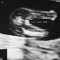 fetal_genitalia_girl_15-16_03.jpg