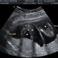 fetal_genitalia_girl_15-16_04.jpg