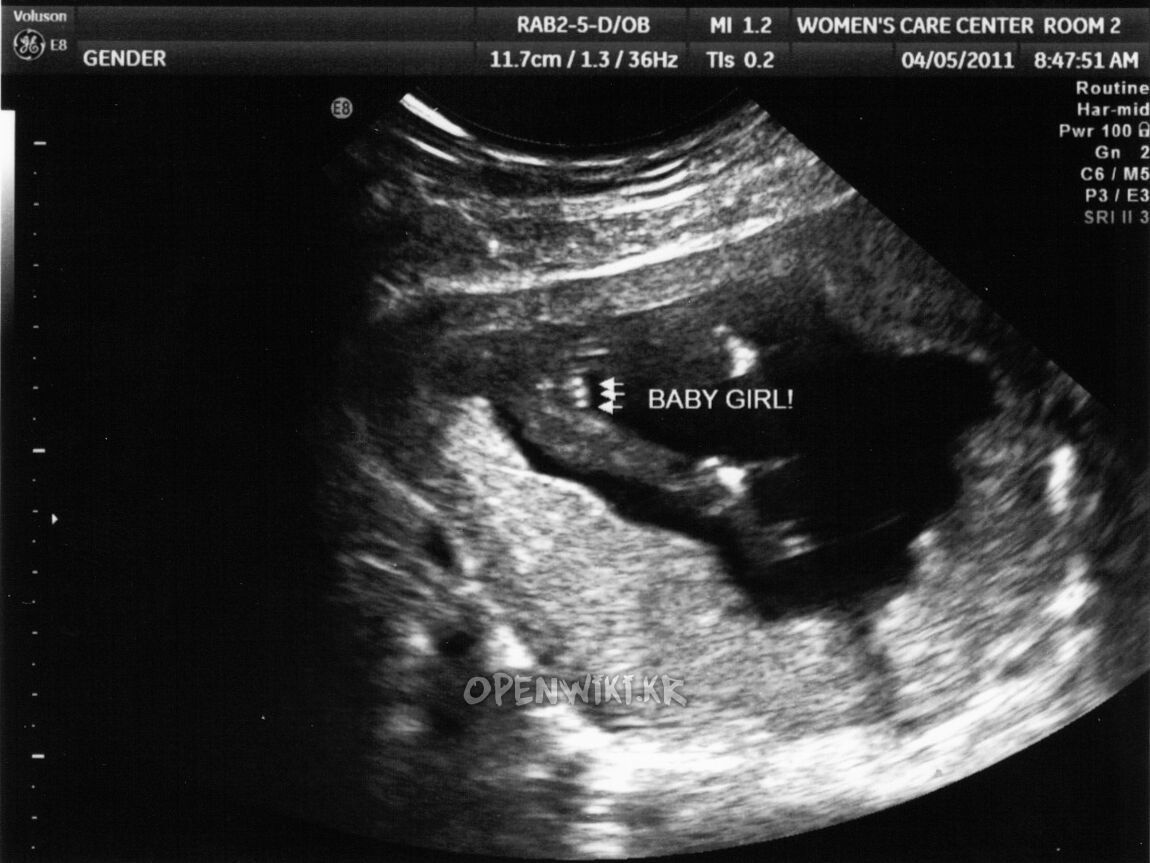 fetal_genitalia_girl_15-16_05.jpg