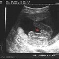 fetal_genitalia_girl_15-16_08.jpg