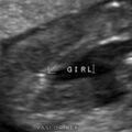 fetal_genitalia_girl_15-16_09.jpg