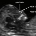 fetal_nasal_bone.jpg