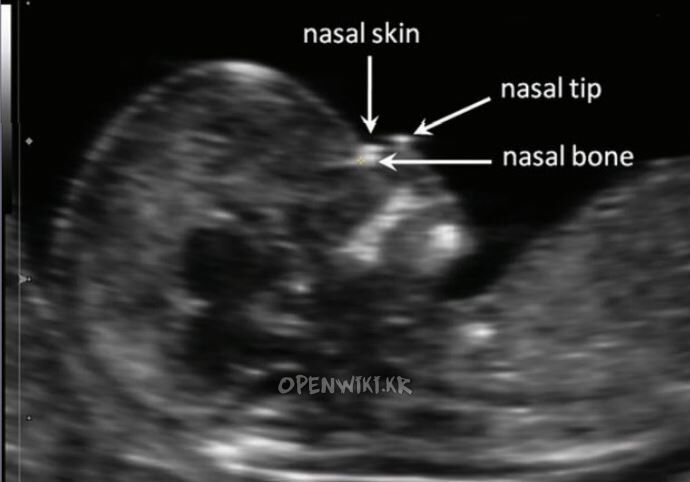 fetal_nasal_bone.jpg