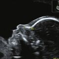 fetal_nasal_bone_24wks.jpg