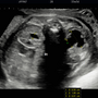 fetal_pyelectasis_2809.png