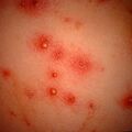 folliculitis9-896.jpg