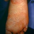 footeczema9-99.jpg.jpg