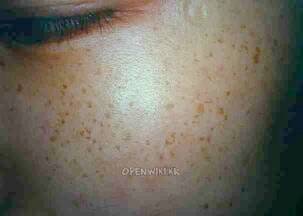 freckles1.jpg