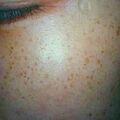 freckles1.jpg
