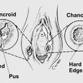 genital_ulcer.jpg