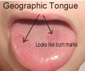 geographic_tongue_0603102437.png