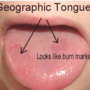 geographic_tongue_0603102437.png
