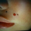 granulomapyogenicum4-886.jpg