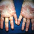 handeczemaatopic.jpg