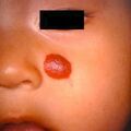 hemangioma5-340.jpg