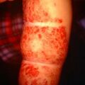 hemangiomacavernous8-748.jpg