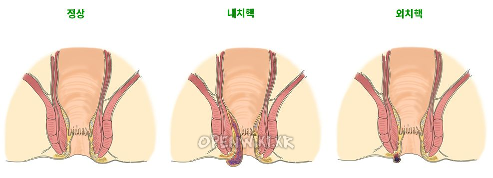 hemorrhoid_1636.png