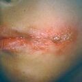herpes5year.jpg