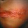 herpes5year2.jpg