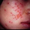 herpes_primary2000-120.jpg