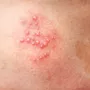 herpes_zoster.png.webp
