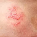 herpes_zoster.webp