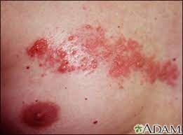 herpes_zoster_2704.png
