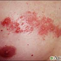 herpes_zoster_2704.png