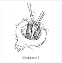 high_ligation_and_complete_closure01.jpg
