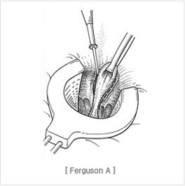 high_ligation_and_complete_closure01.jpg