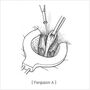 high_ligation_and_complete_closure01.jpg