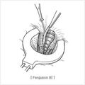 high_ligation_and_complete_closure02.jpg