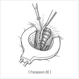 high_ligation_and_complete_closure02.jpg