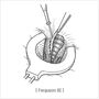 high_ligation_and_complete_closure02.jpg