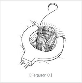 high_ligation_and_complete_closure03.jpg